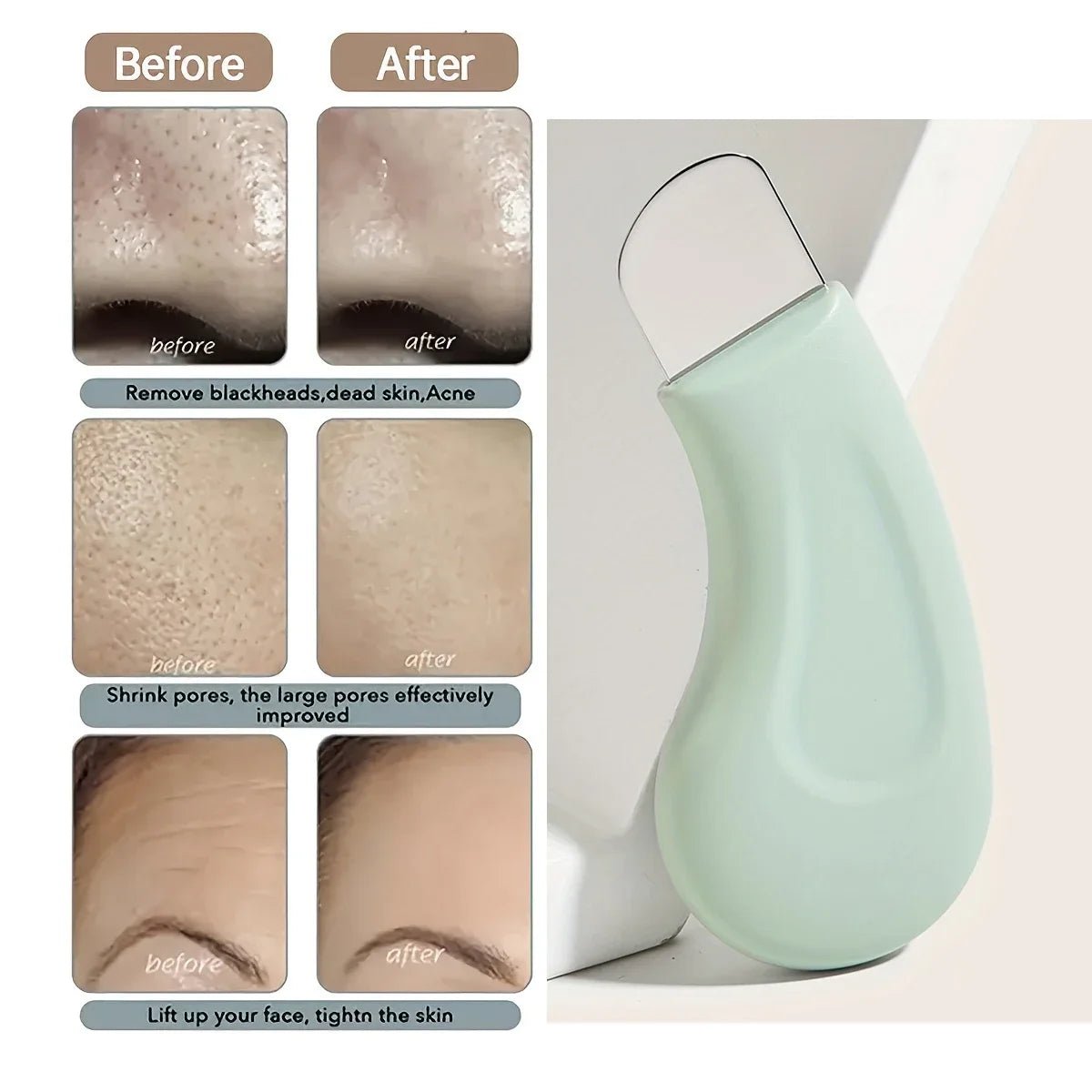 Precision Pore Cleaner Tool - Blackhead & Whitehead Remover for Face and Nose - Nordshop Hamburg